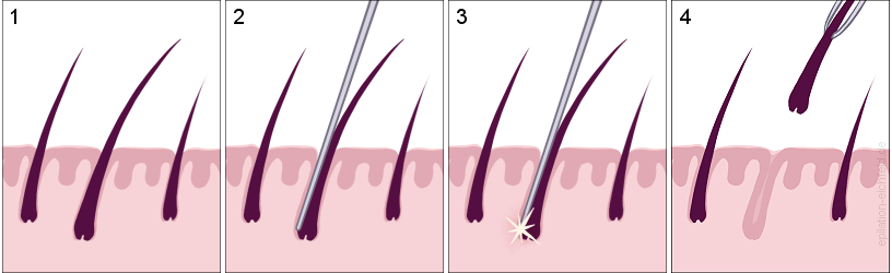 needle insertion into the follicle and destruction of germination cells with heat